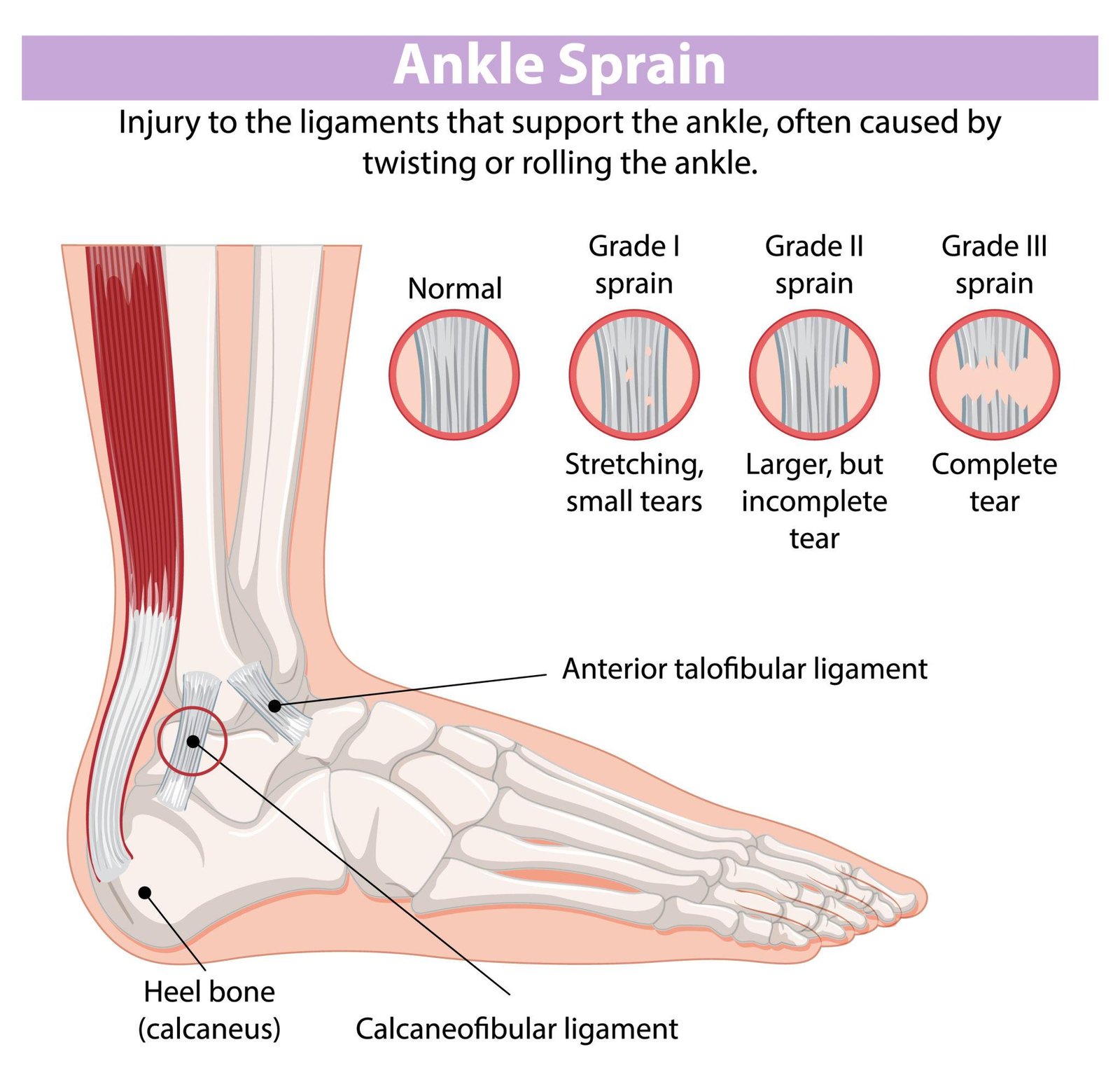 Reijury Risk Ankle Sprain – netsport.ca